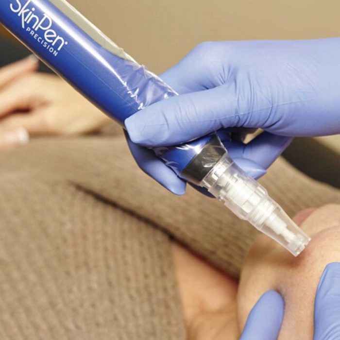 SkinPen Deluxe Microneedling
